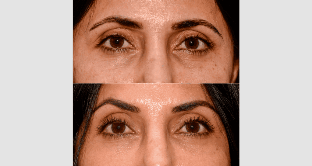 Nahaufnahme von Augenbrauen vor und nach Hautbehandlung, Hautbild verbessert.