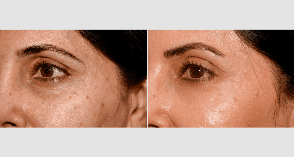 Vergleich der Haut vor und nach Aknebehandlung, Hautbild verbessert sich deutlich.