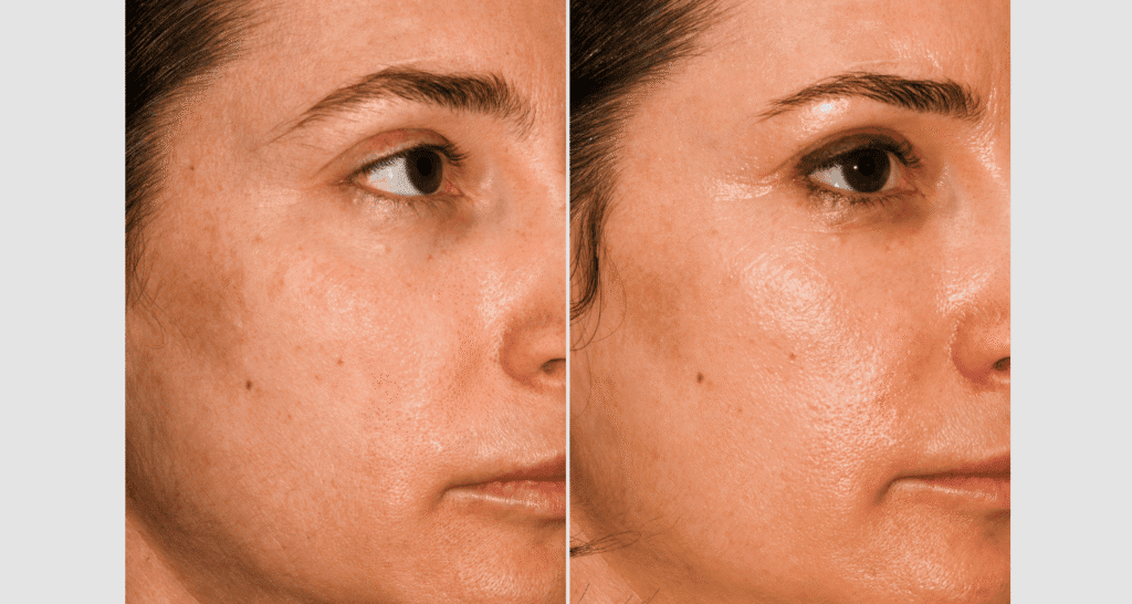 Vorher-Nachher Vergleich einer Hautbehandlung gegen Akne und Pigmentflecken.