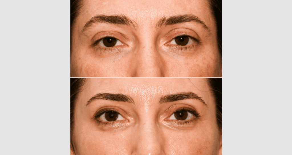 Nahaufnahme von Haut vor und nach einer Hautbehandlung, Fokus auf Hautverbesserung.