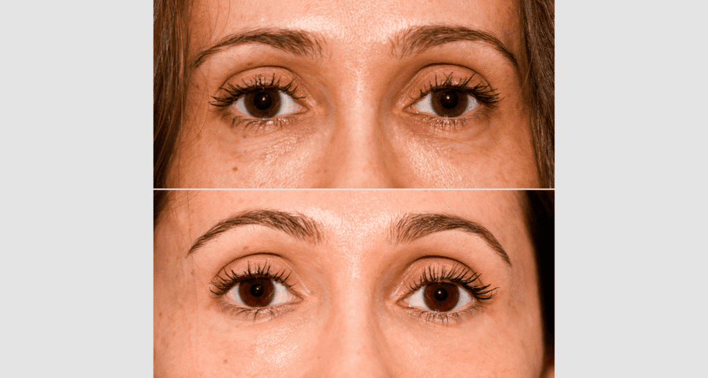 Nahaufnahme von Augenpartie vor und nach Botox-Behandlung.