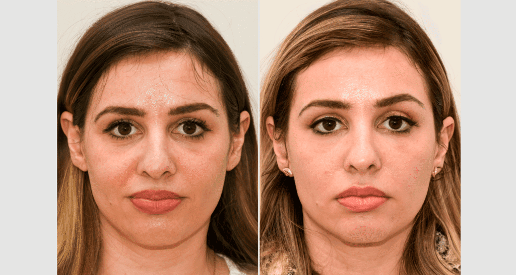 Vorher-nachher Vergleich einer Hautbehandlung bei einer Frau.