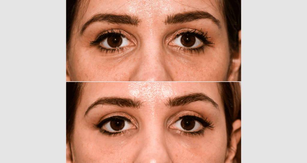 Nahaufnahme eines Gesichts mit Hautunreinheiten vor und nach Hautpflegebehandlung.