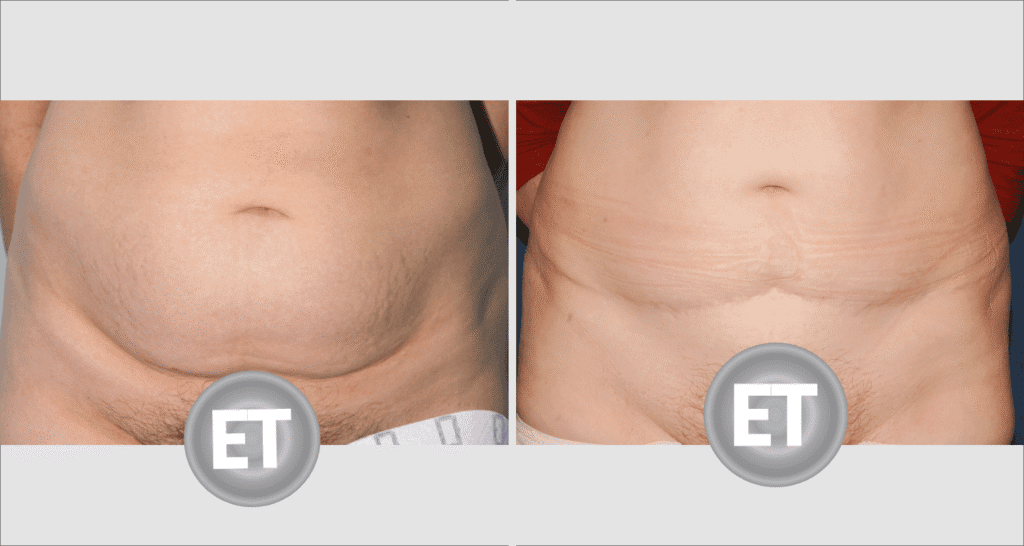 Vorher/Nachher Ergebnis: Bauchdeckenstraffung