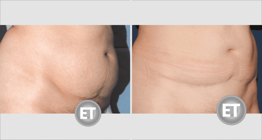 Vorher/Nachher Ergebnis: Bauchdeckenstraffung