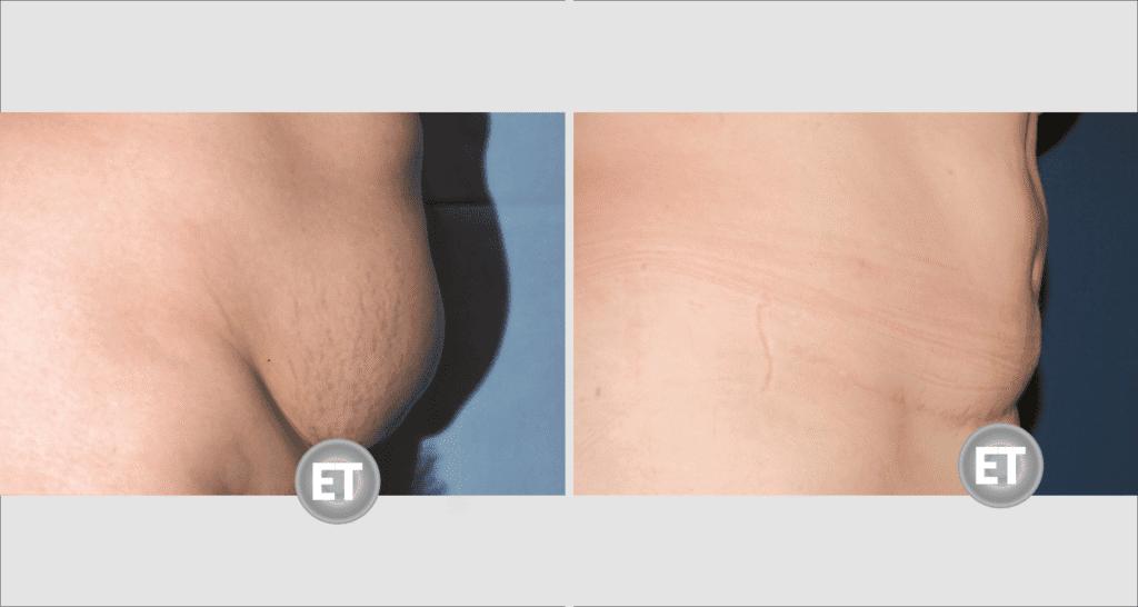 Vorher/Nachher Ergebnis: Bauchdeckenstraffung