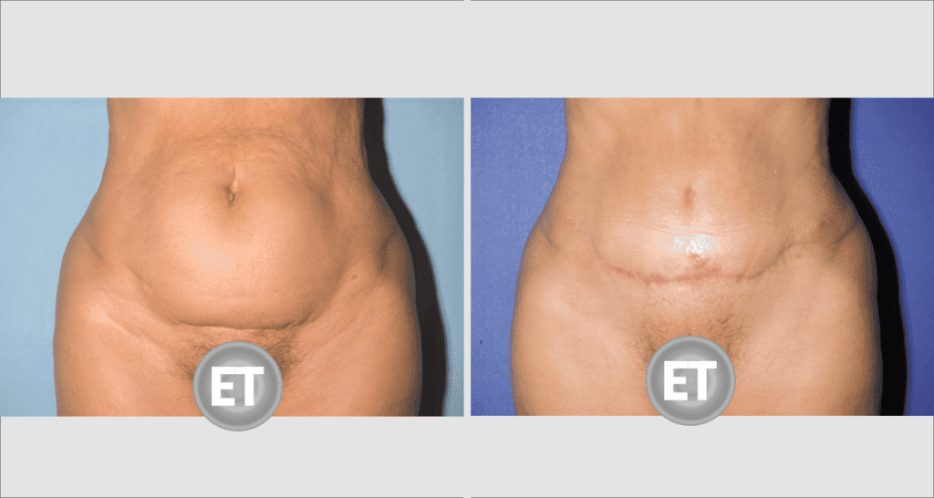 Vorher/Nachher Ergebnis: Bauchdeckenstraffung