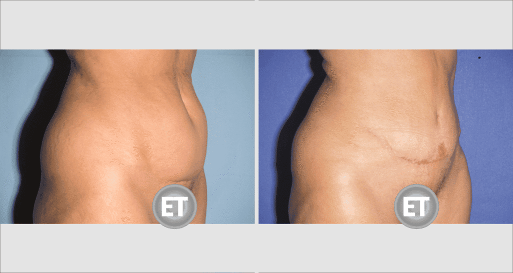 Vorher/Nachher Ergebnis: Bauchdeckenstraffung