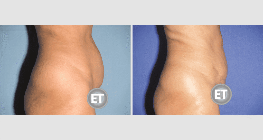 Vorher/Nachher Ergebnis: Bauchdeckenstraffung