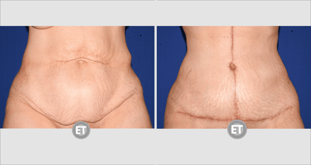 Vorher/Nachher Ergebnis: Bauchdeckenstraffung