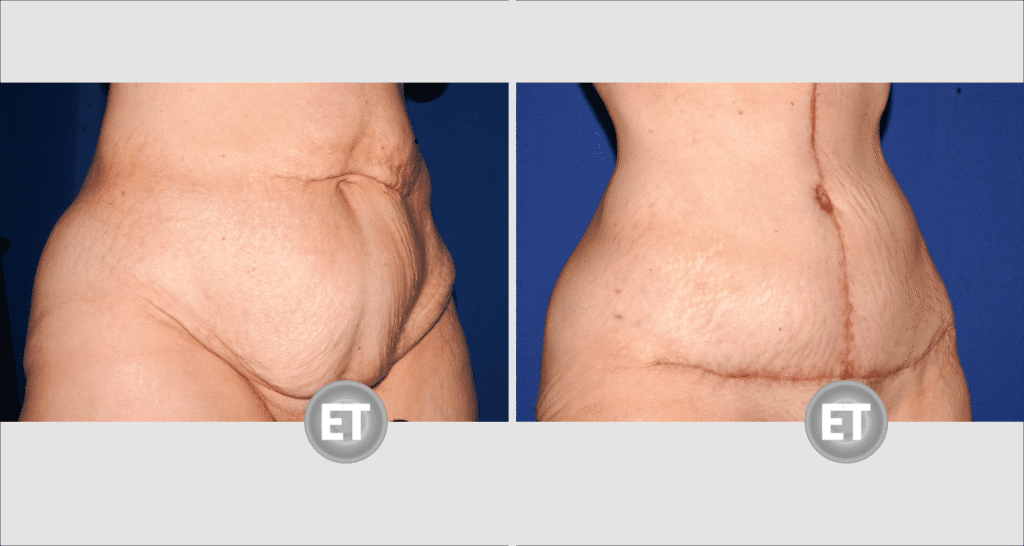 Vorher/Nachher Ergebnis: Bauchdeckenstraffung