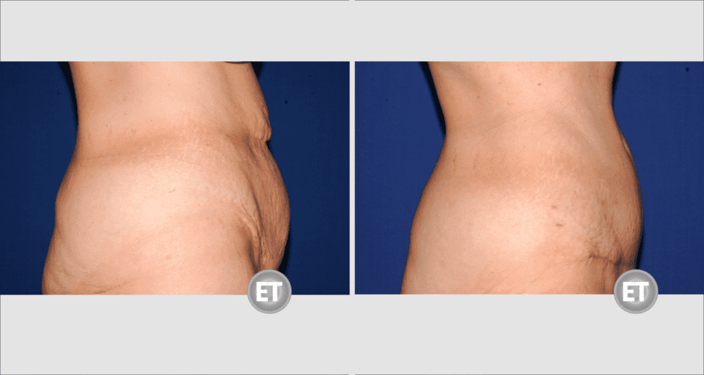 Vorher/Nachher Ergebnis: Bauchdeckenstraffung