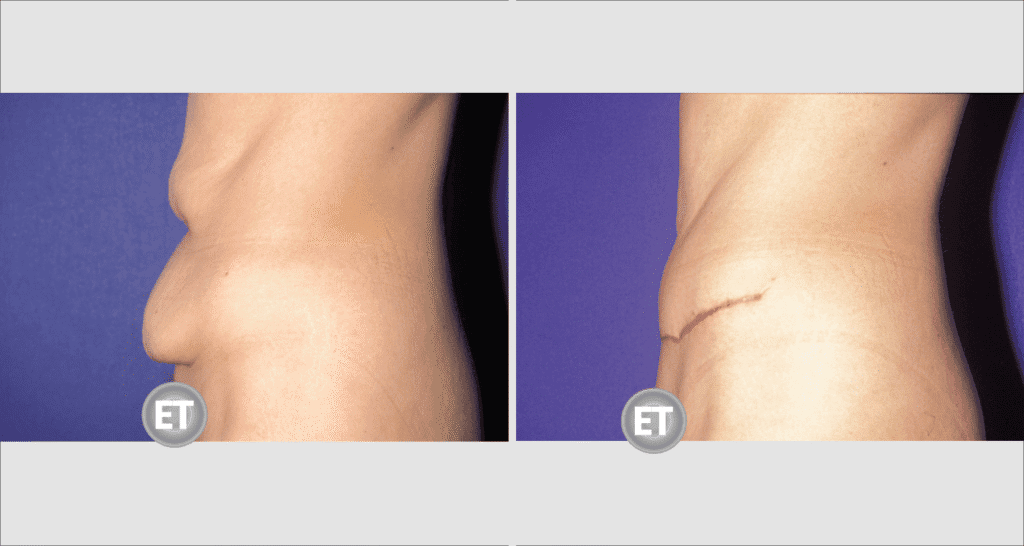 Vorher/Nachher Ergebnis: Bauchdeckenstraffung