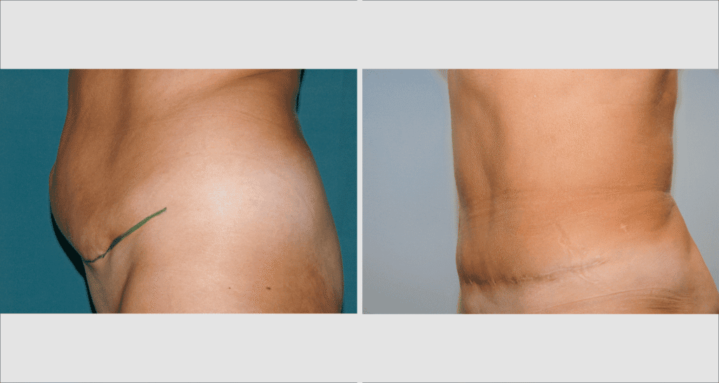 Vorher/Nachher Ergebnis: Bauchdeckenstraffung