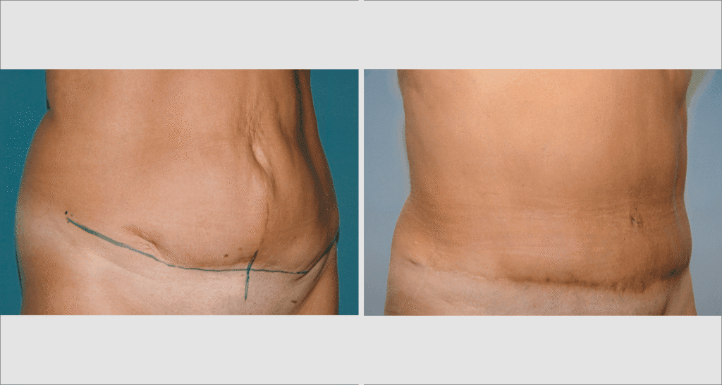Vorher/Nachher Ergebnis: Bauchdeckenstraffung