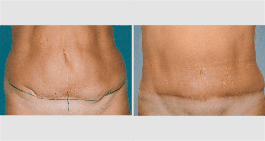 Vorher/Nachher Ergebnis: Bauchdeckenstraffung
