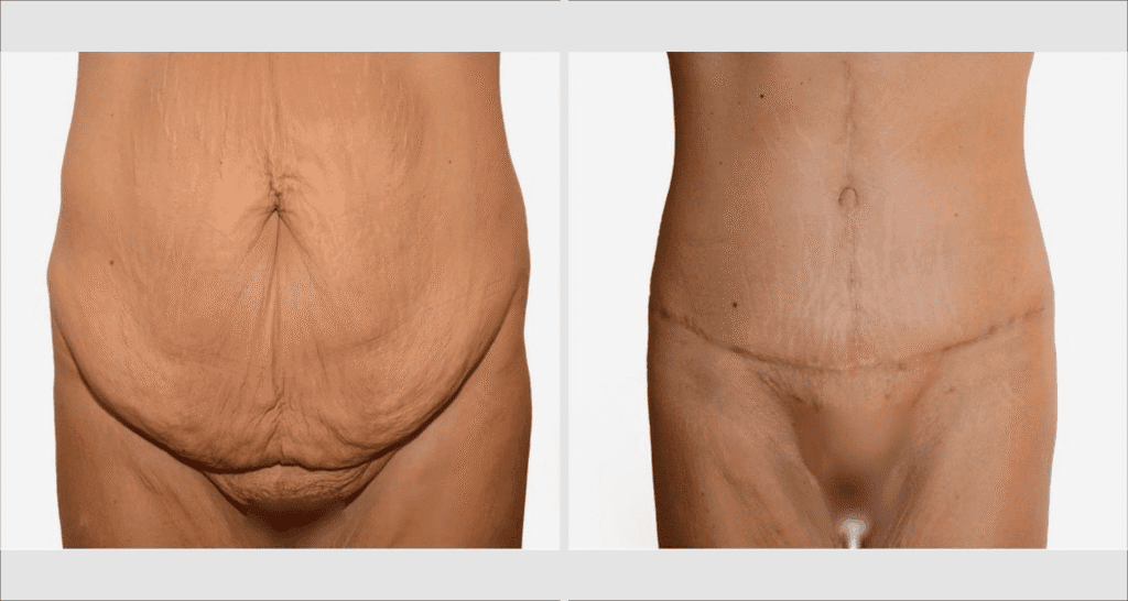 Vorher/Nachher Ergebnis: Bauchdeckenstraffung