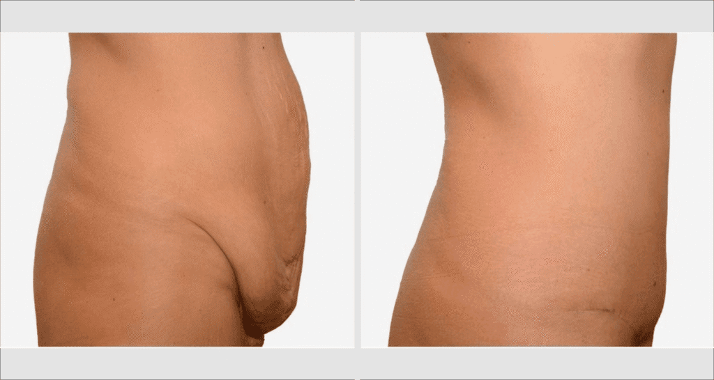 Vorher/Nachher Ergebnis: Bauchdeckenstraffung