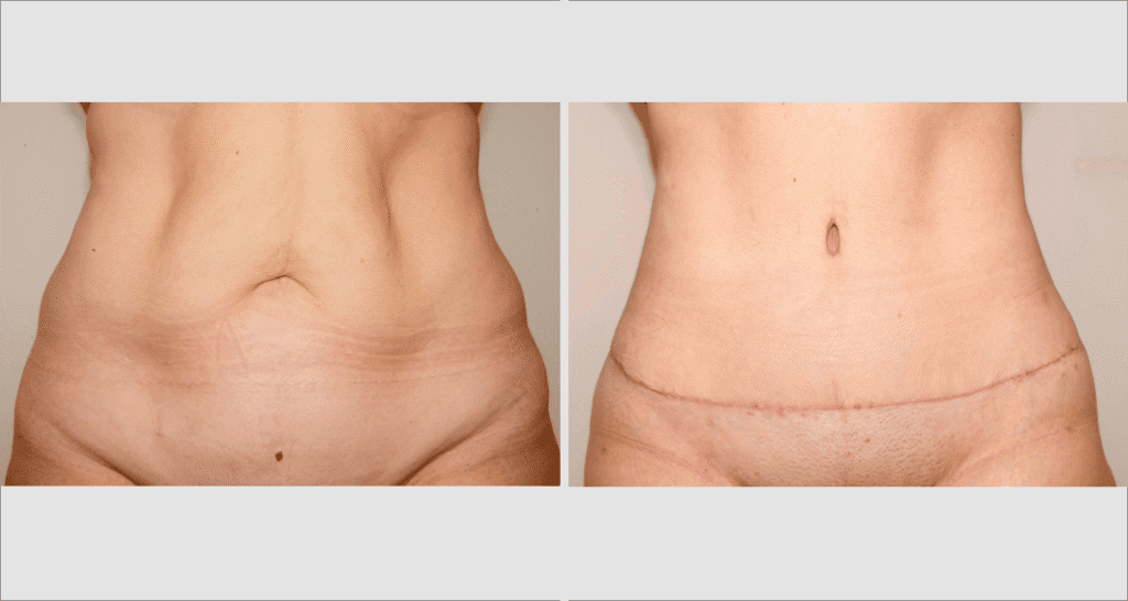 Vorher/Nachher Ergebnis: Bauchdeckenstraffung