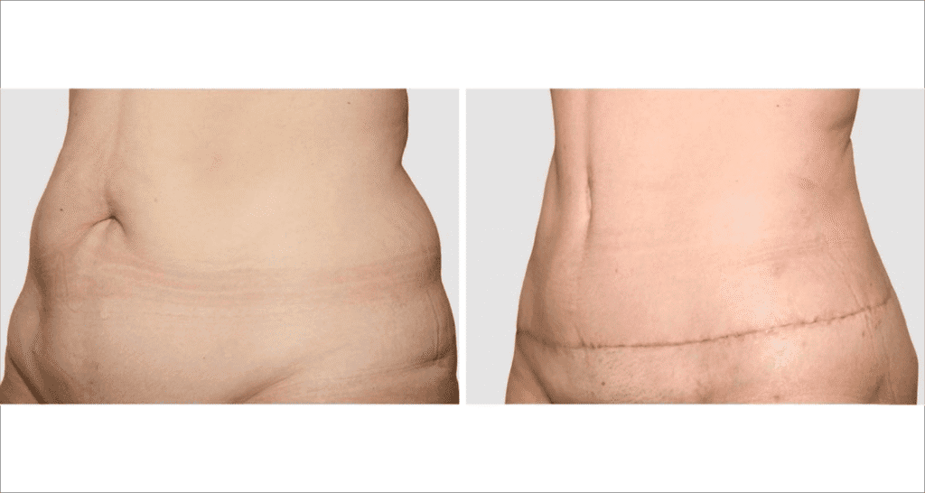 Vorher/Nachher Ergebnis: Bauchdeckenstraffung