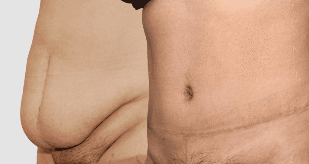 Vorher/Nachher Ergebnis: Bauchdeckenstraffung