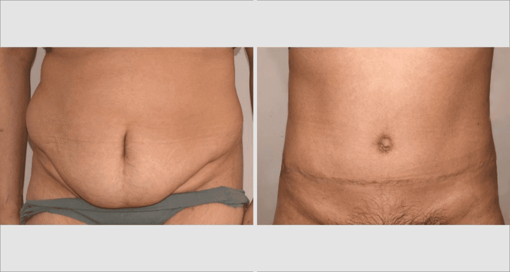 Vorher/Nachher Ergebnis: Bauchdeckenstraffung