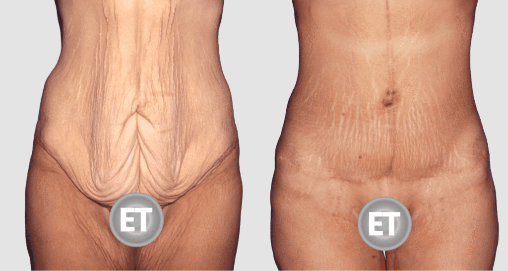 Vorher/Nachher Ergebnis: Bauchdeckenstraffung