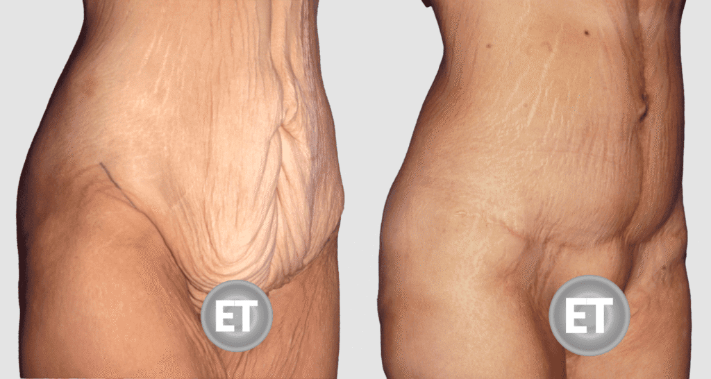 Vorher/Nachher Ergebnis: Bauchdeckenstraffung