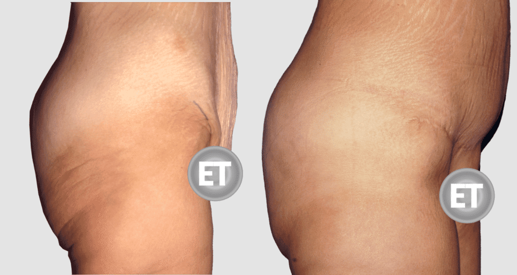 Vorher/Nachher Ergebnis: Bauchdeckenstraffung