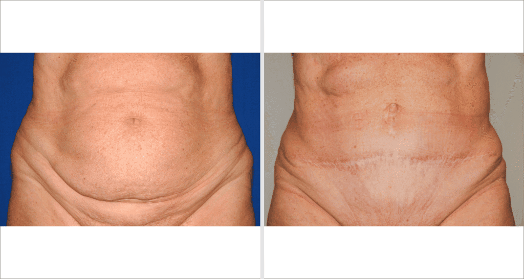 Vorher/Nachher Ergebnis: Bauchdeckenstraffung