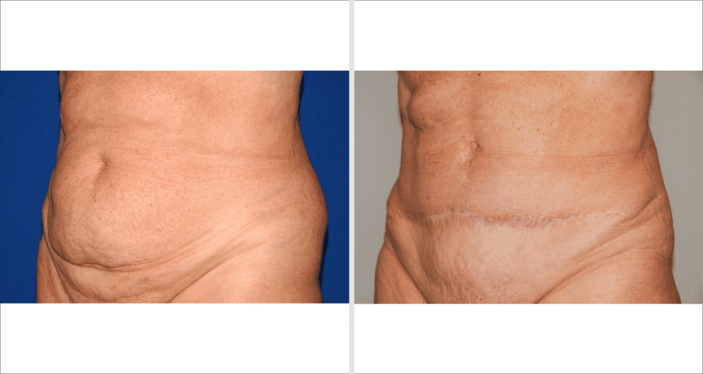 Vorher/Nachher Ergebnis: Bauchdeckenstraffung