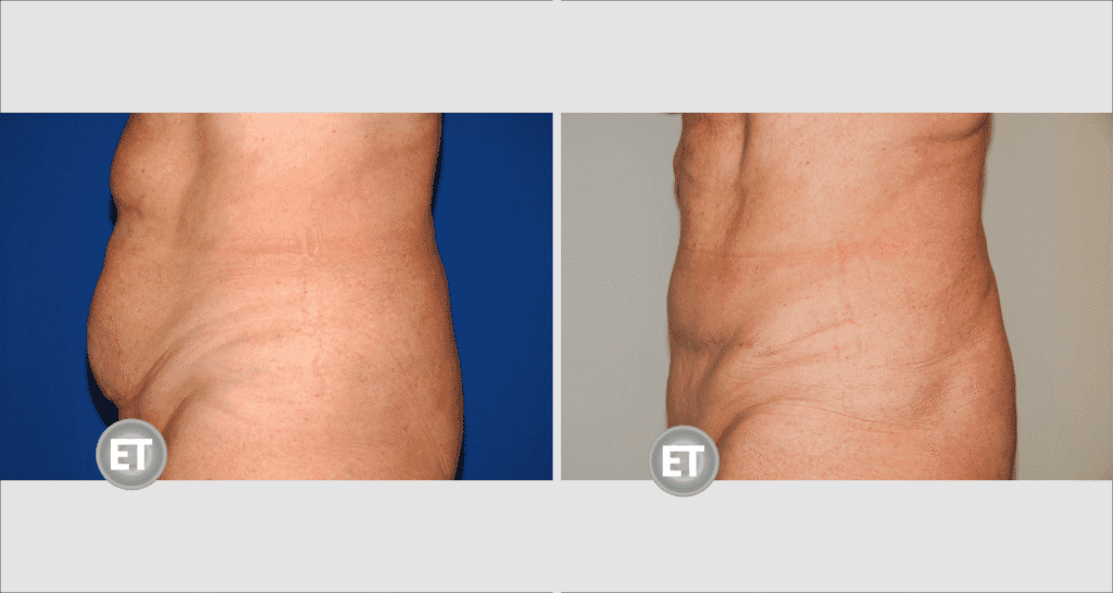 Vorher/Nachher Ergebnis: Bauchdeckenstraffung