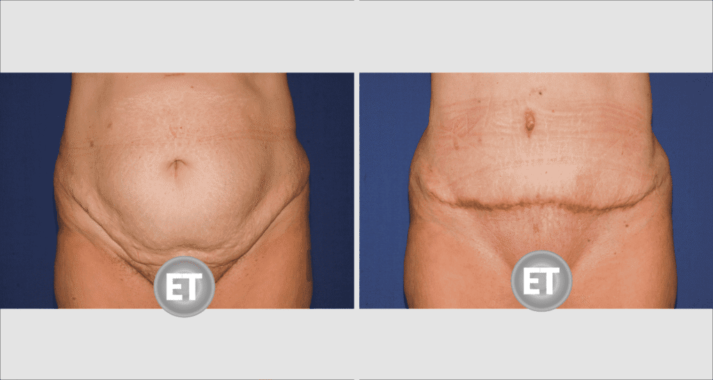 Vorher/Nachher Ergebnis: Bauchdeckenstraffung