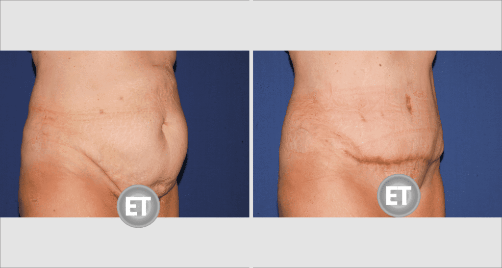 Vorher/Nachher Ergebnis: Bauchdeckenstraffung