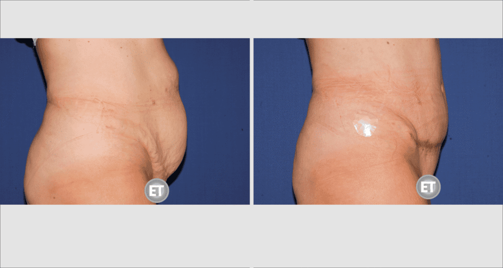 Vorher/Nachher Ergebnis: Bauchdeckenstraffung