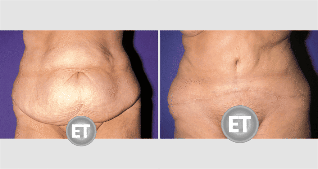 Vorher/Nachher Ergebnis: Bauchdeckenstraffung