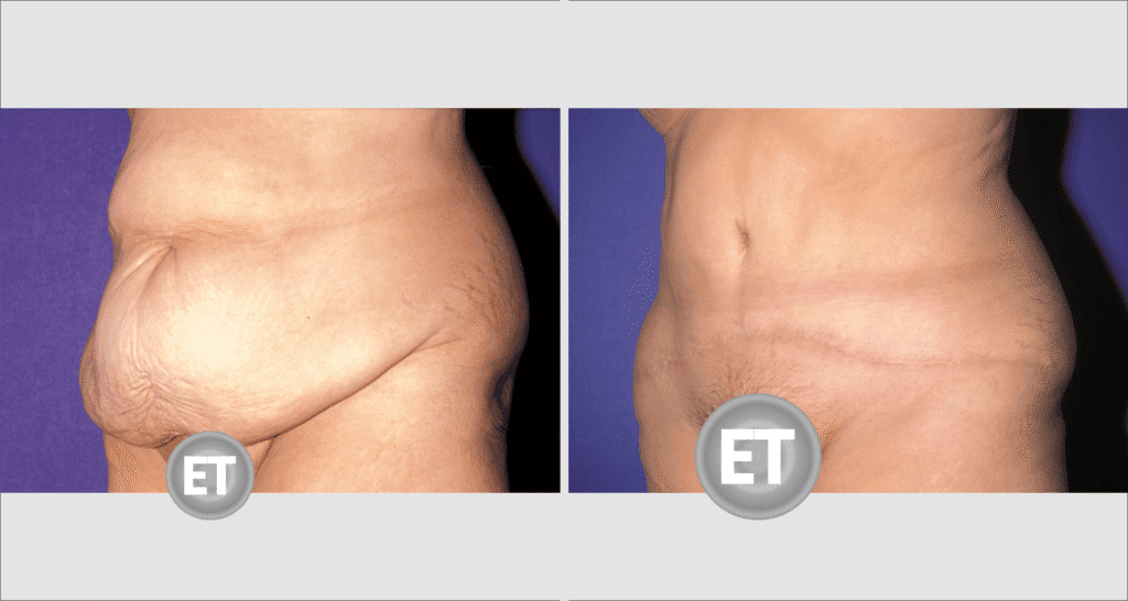 Vorher/Nachher Ergebnis: Bauchdeckenstraffung