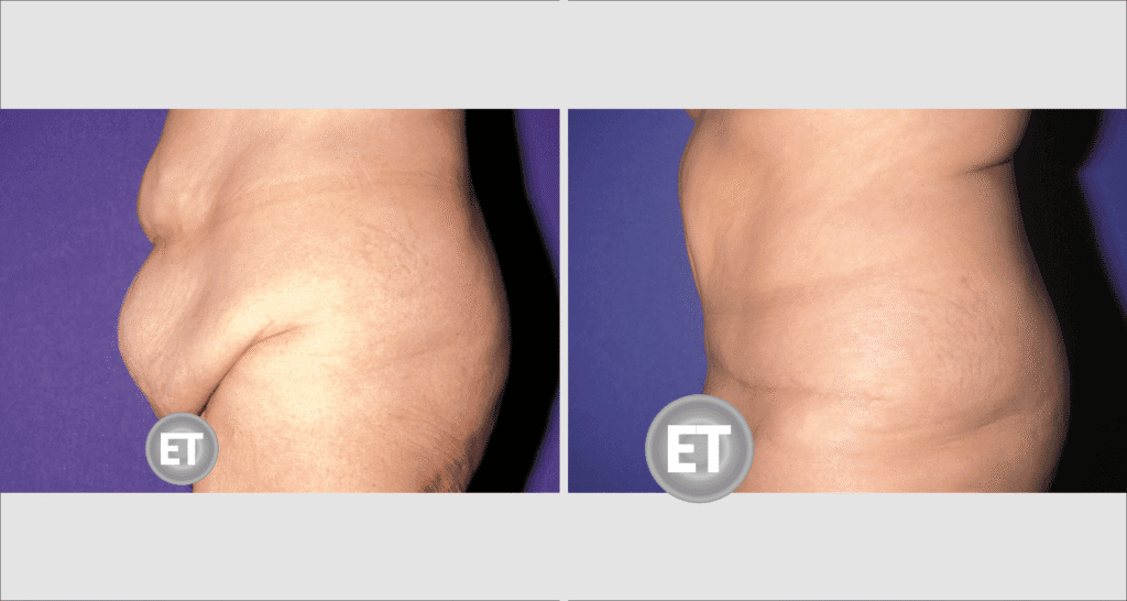 Vorher/Nachher Ergebnis: Bauchdeckenstraffung