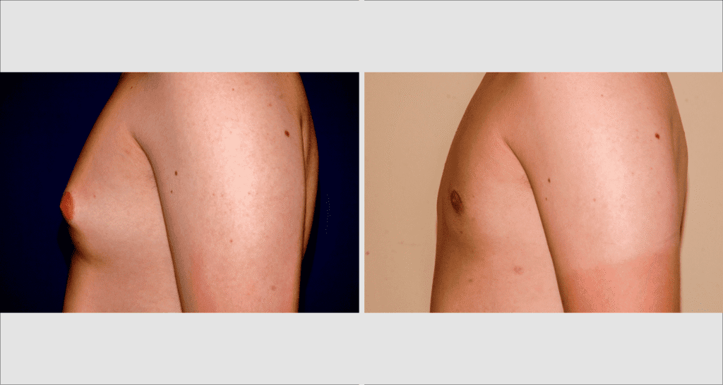 Vorher/Nachher Ergebnis: Bilder Gynaekomastie