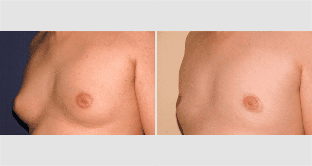 Vorher/Nachher Ergebnis: Bilder Gynaekomastie