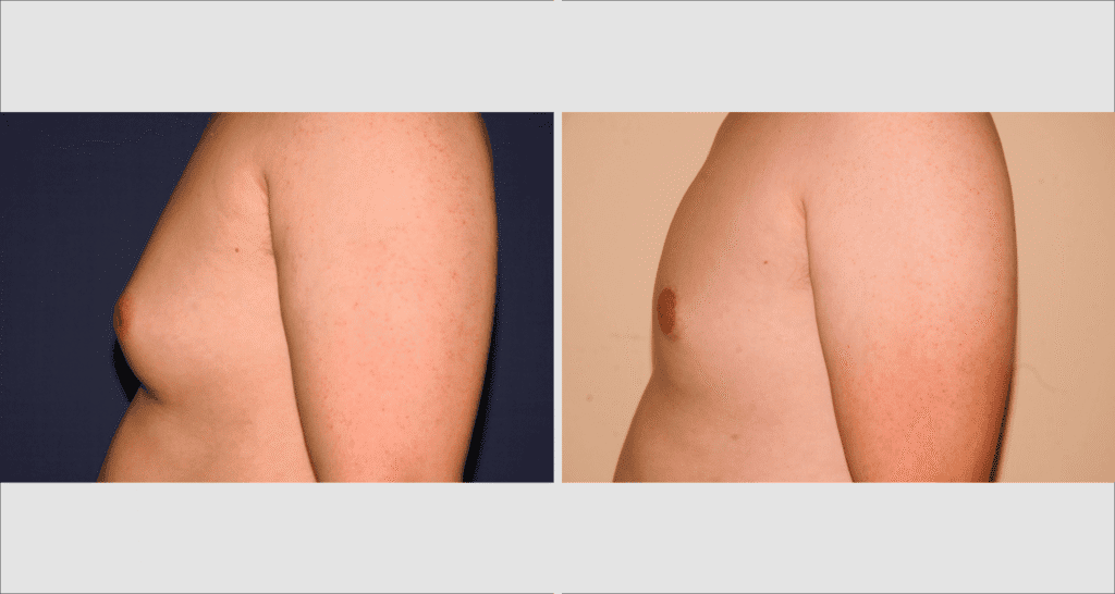 Vorher/Nachher Ergebnis: Bilder Gynaekomastie