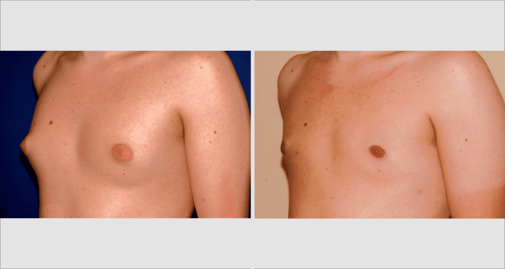 Vorher/Nachher Ergebnis: Bilder Gynaekomastie