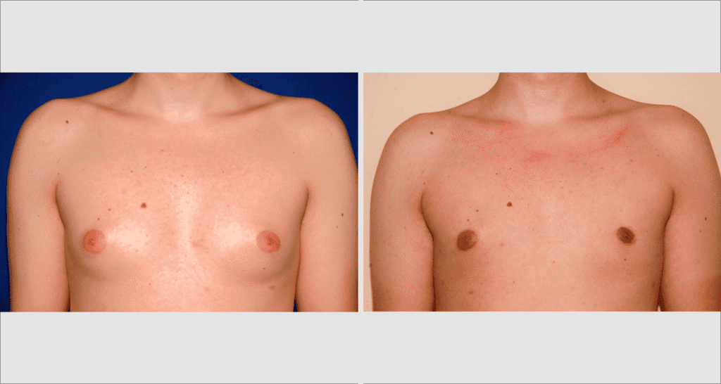 Vorher/Nachher Ergebnis: Bilder Gynaekomastie