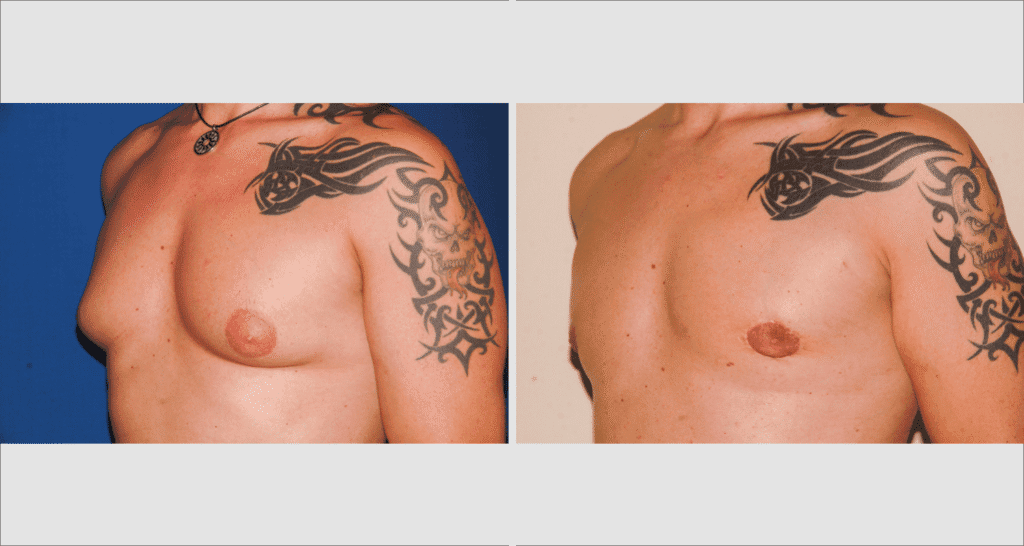 Vorher/Nachher Ergebnis: Bilder Gynaekomastie