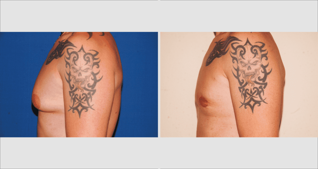 Vorher/Nachher Ergebnis: Bilder Gynaekomastie