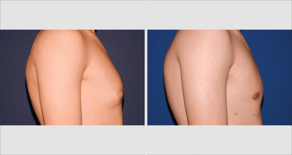 Vorher/Nachher Ergebnis: Bilder Gynaekomastie