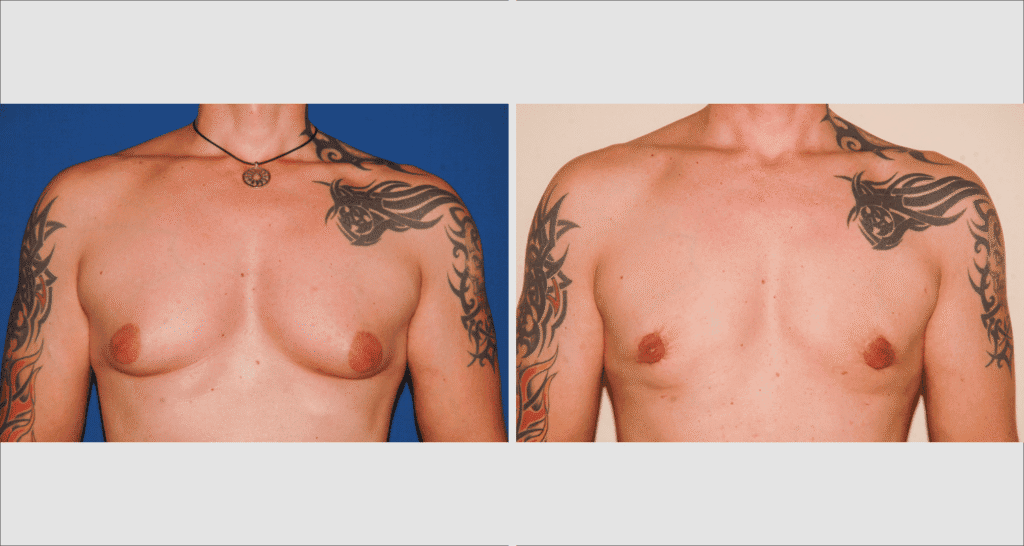 Vorher/Nachher Ergebnis: Bilder Gynaekomastie