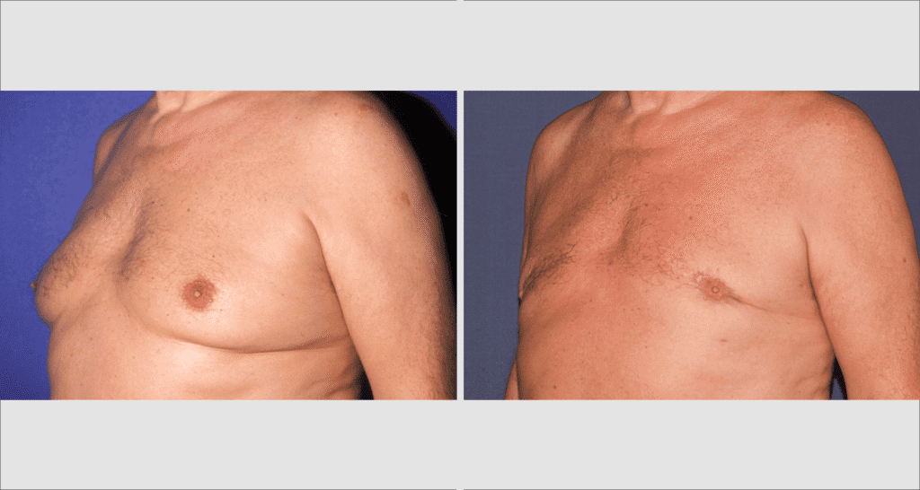 Vorher/Nachher Ergebnis: Bilder Gynaekomastie