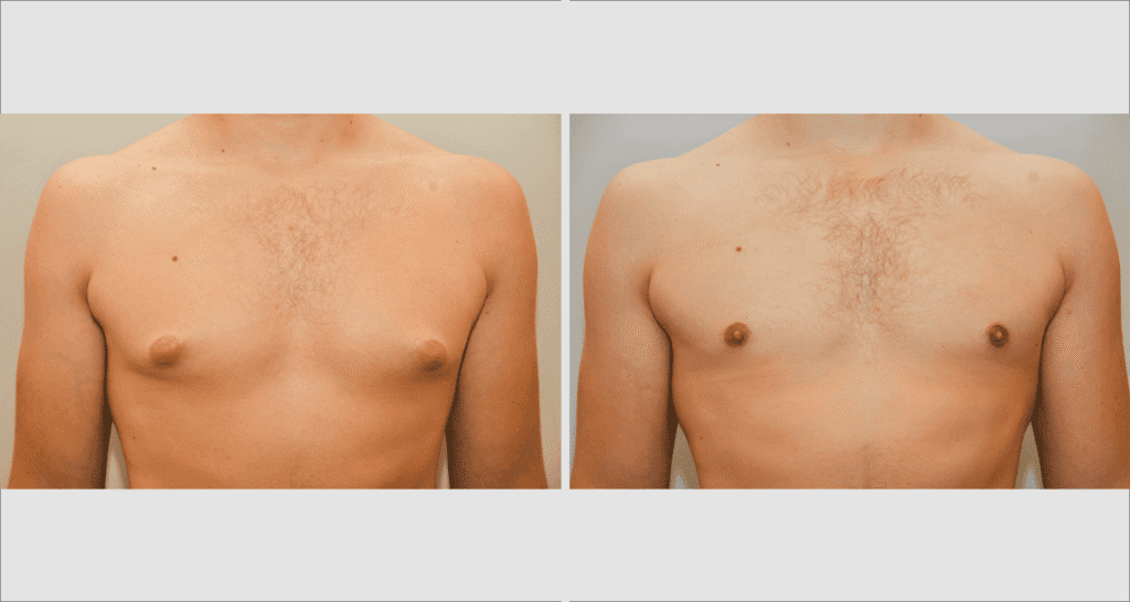 Male chest before and after gynaecomastia treatment, showing reduction of breast tissue.