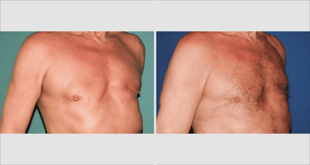 Vorher/Nachher Ergebnis: Bilder Gynaekomastie